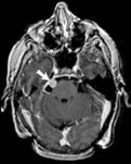 cerebellopontine angle tumor, Gamma Knife Surgery, Georgia Regents Neuroscience Center